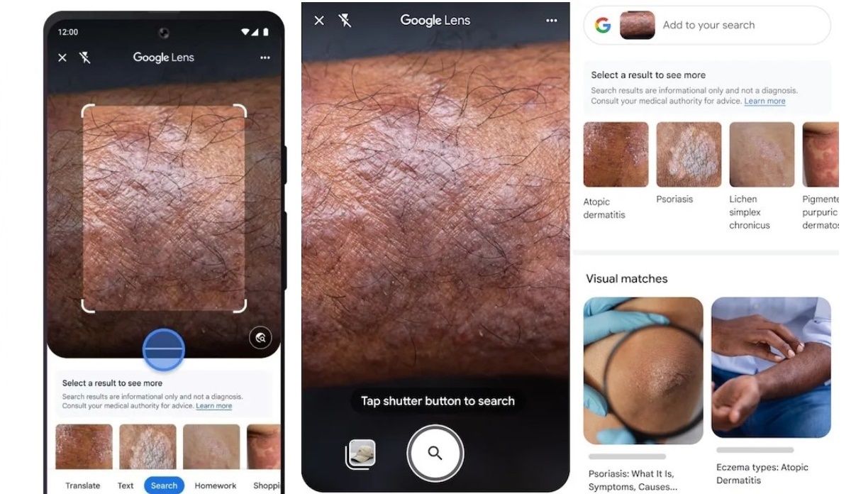 Google Lens cambiará la forma en que detectas enfermedades de tu piel